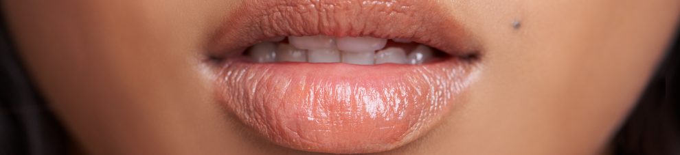 Lip Fillers